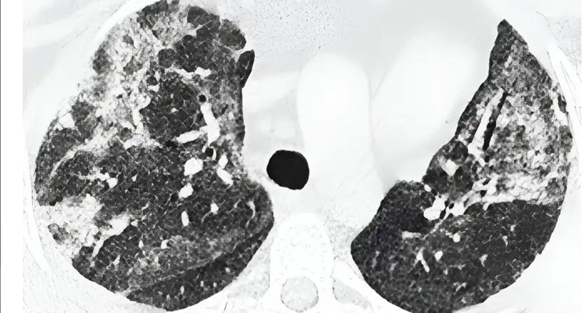 Tomografía computarizada de alta resolución de los pulmones de un paciente con un caso fatal de autoinmunidad MDA5 y MIP-C./ canariasnoticias.es