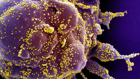 célula apoptótica infectada con partículas del virus SARS-COV-2