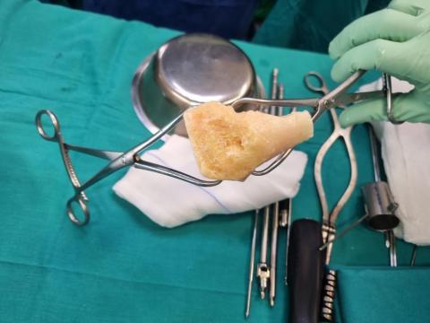 Cirugía con injerto de hueso cirugía con injerto de hueso